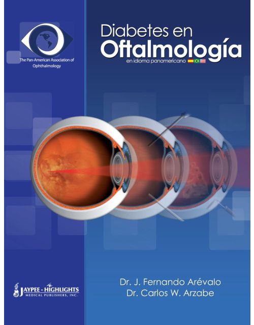 Diabetes en Oftalmologia
